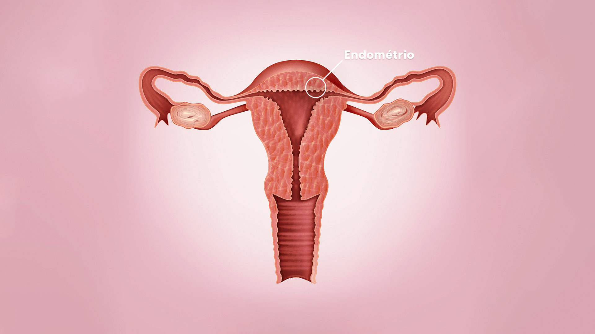 O que é endometriose?