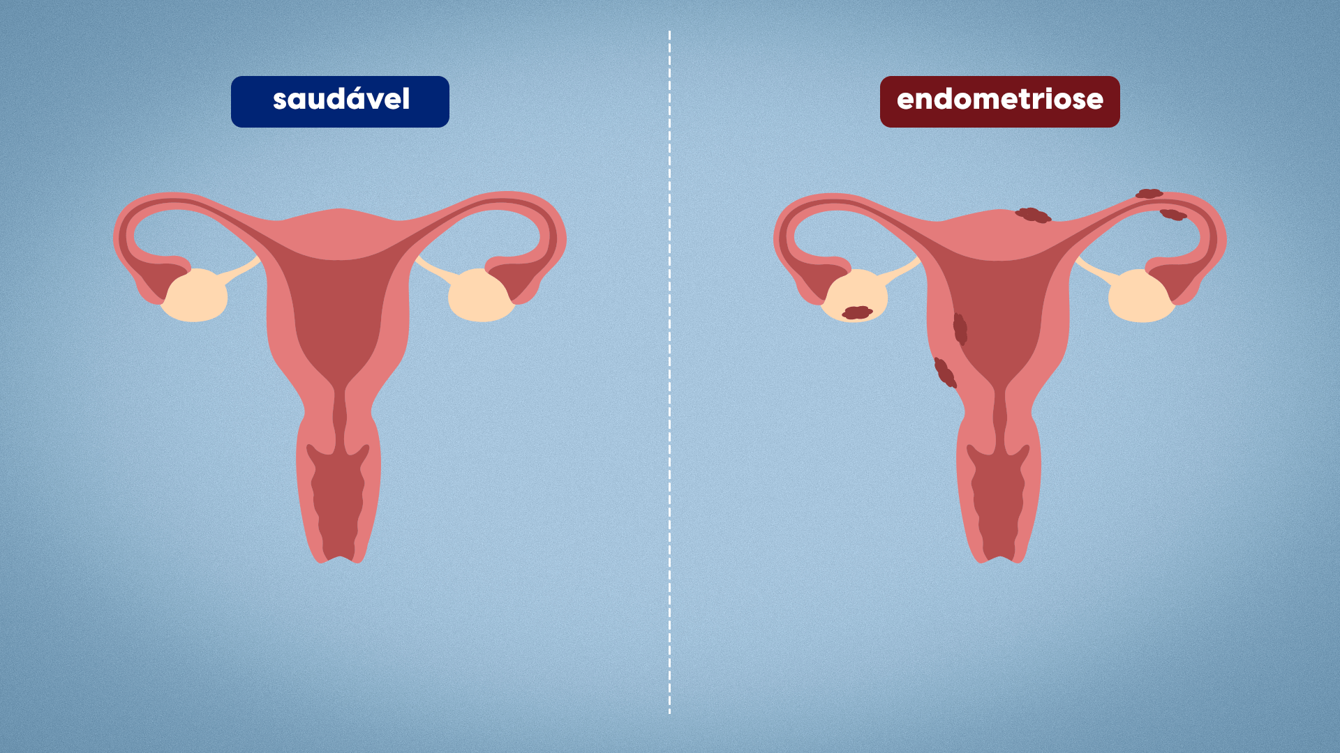 O que é endometriose?